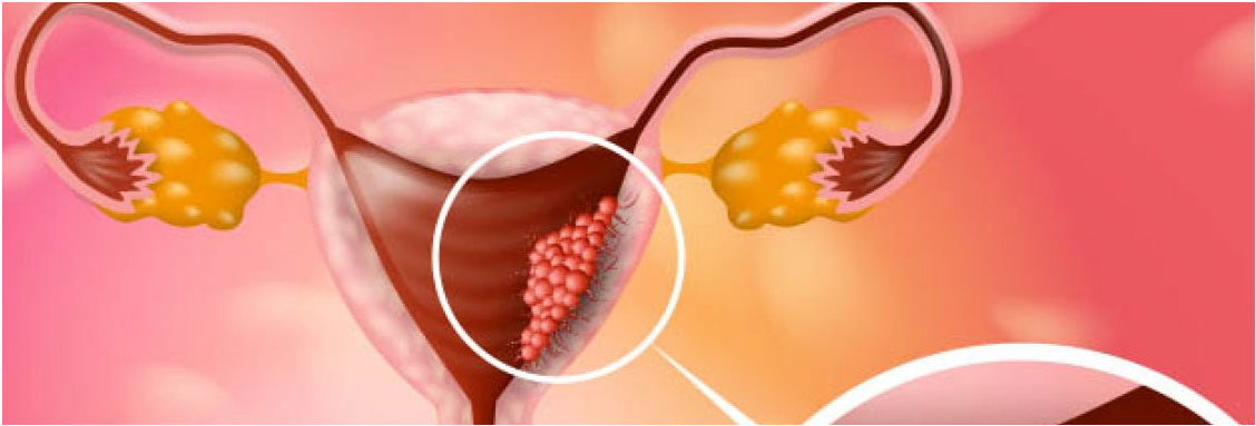 ENDOMETRİUM KANSERİNDE MOLEKÜLER SINIFLAMA VE YÖNETİME ETKİSİ